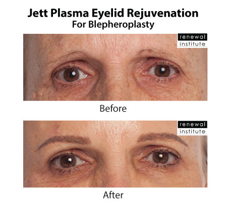 Jett Plasma Eyelid Before and after