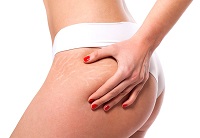 Everything you need to know about Stretch Marks